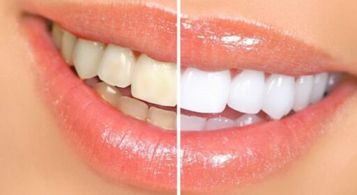 WHY DOES MY TEETH TURN YELLOW AFTER USING THE ELECTRIC TOOTHBRUSH?